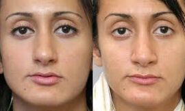 Why Does Rhinoplasty Cost Vary in Dubai?