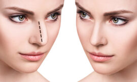 Safe and Effective Nose Surgery: Rhinoplasty in Riyadh