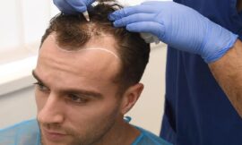 What Is the True Cost of Hair Restoration?