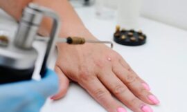 Skin Wart Removal Costs by Treatment Type