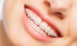 Understanding the Different Types of Braces