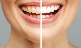 How Teeth Whitening in Dubai Can Enhance Your Confidence