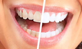 Say Goodbye to Stains: Teeth Whitening in Dubai Explained