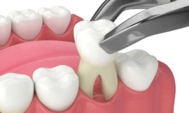 The Most Affordable Tooth Extraction Clinics in Dubai A Patient’s Guide