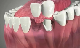 The Role of Adhesive Dentistry in Crown and Bridge Placement