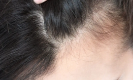 The Science of Hair Regrowth Dubai’s Most Advanced Treatments