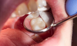 The Lifespan of Dental Fillings and When to Replace Them