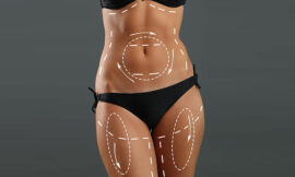 Factors to Consider Before Undergoing a Tummy Tuck Procedure