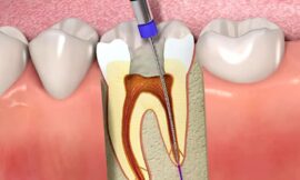 What Are the Signs That Your Root Canal Didn’t Work as Expected