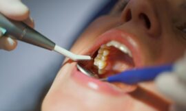 What Is the Best Way to Care for Teeth After a Filling