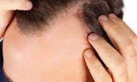 Will My Hair Look Natural After a 1 Dirham Hair Transplant in Duba