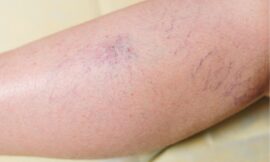 Will My Insurance Cover Spider Vein Treatment in Dubai