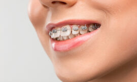 Invisalign Clear Aligners: A Modern Solution for a Confident Smile