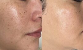 Pico Laser Treatment: Everything You Need to Know for a Radiant Look