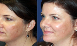 Fractional CO2 Laser Treatment Cost for Different Skin Types