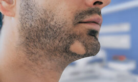 What to Expect from a Beard Implant Procedure?