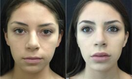 Can Cheek Augmentation Be Combined With Other Facial Procedures