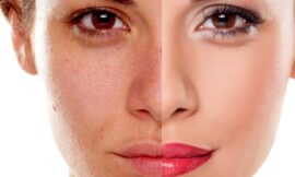 Can Home Remedies Replace Professional Pigmentation Treatment in Dubai