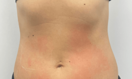 Can Laser Liposuction Help Define Abs and Improve Muscle Contours