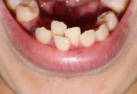 Read more about the article How to Correct Crowded Teeth and Improve Your Smile