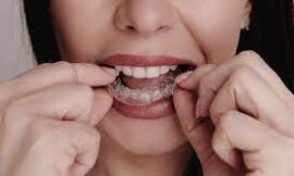 Straightening Teeth Has Never Been Easier with Aligners