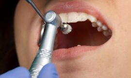 Does Teeth Cleaning Help Prevent Tooth Decay?