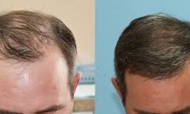 Do Hair Transplants in Dubai Work for Women Experiencing Hair Loss