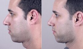 From Ordinary to Extraordinary: Rhinoplasty Revealed