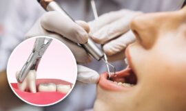 Debunking Common Wisdom Tooth Extraction Myths