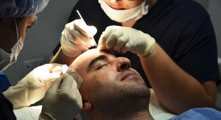 Read more about the article How long do hair transplants last?