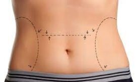 How Do I Choose the Right Tummy Tuck Type for My Body Goals