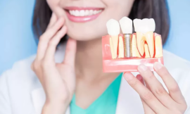 How Soon Can I Eat Normally After Getting Dental Implants in Dubai