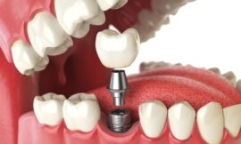 Enhancing Your Quality of Life with Dental Implants