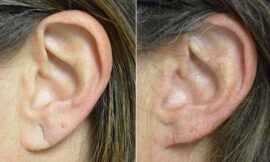 Is Earlobe Correction Surgery in Dubai a Permanent Solution for Sagging Lobes