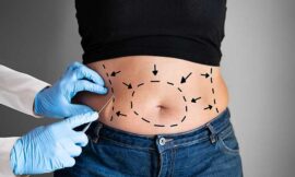 How Many Sessions Of Liposuction Do I Need?