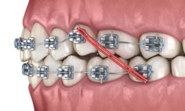 Orthodontics Market: Growth Trends, Key Drivers, and Future Outlook