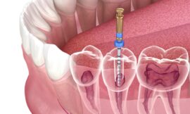 Step-by-Step Root Canal Treatment Process in Dubai