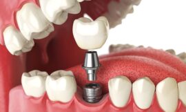 How Painful is a Single Tooth Implant? Know the Facts