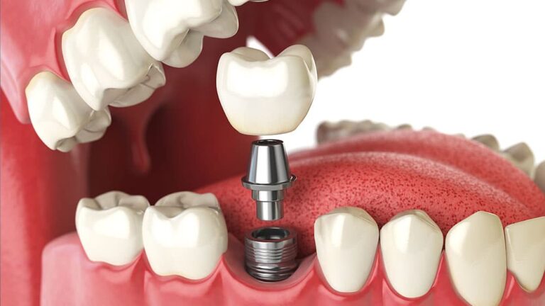 Read more about the article How Painful is a Single Tooth Implant? Know the Facts