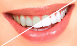 Brighten Your Smile with Teeth Whitening in Dubai