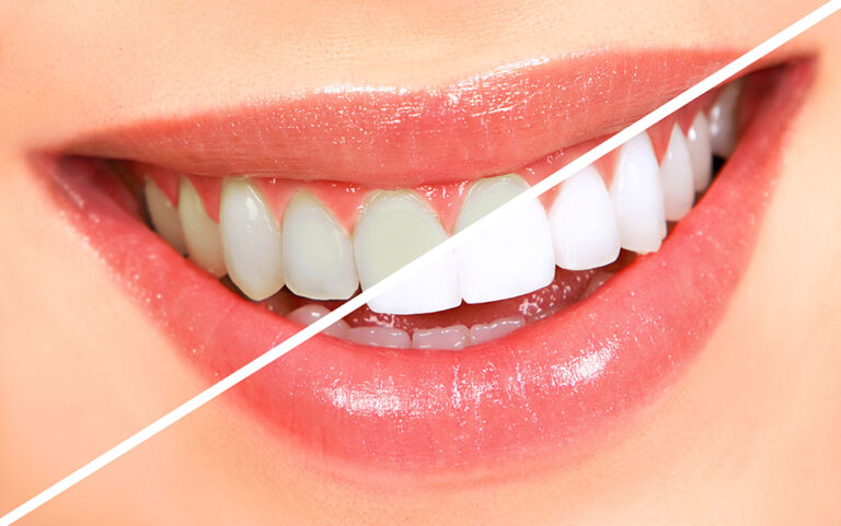 Read more about the article Brighten Your Smile with Teeth Whitening in Dubai