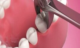 Tooth Extraction in Dubai: What to Expect Before, During, and After