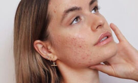 What Is the Best Skincare Treatment for Acne Scars?