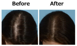 Will PRP Therapy in Dubai Work for Genetic Hair Loss