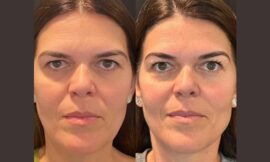 How Long Do Thread Lift Results Last? Answers from the Best Aesthetic Clinic in Dubai