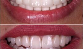 Are E-Max Veneers Safe for People with Allergies in Dubai