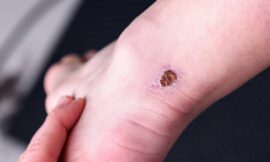 What Causes an Infected Wound?