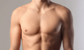 Steroid-Induced Gynecomastia: Managing Hormone Imbalance in Athletes