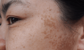 The Best Approaches to Managing Melasma for Clearer Skin
