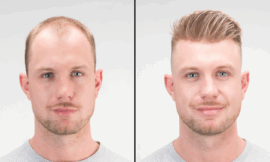 Hair Replacement for Thinning Hair: What to Expect